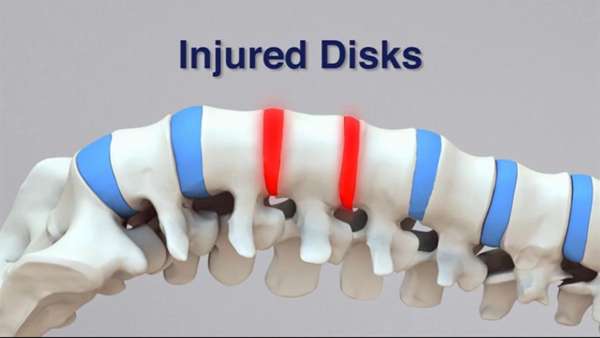 Smyrna, GA non-surgical spinal decompression